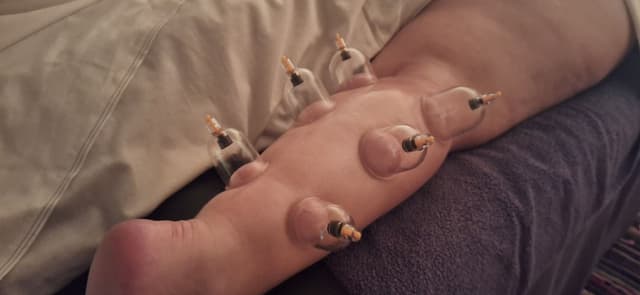 Cupping therapy