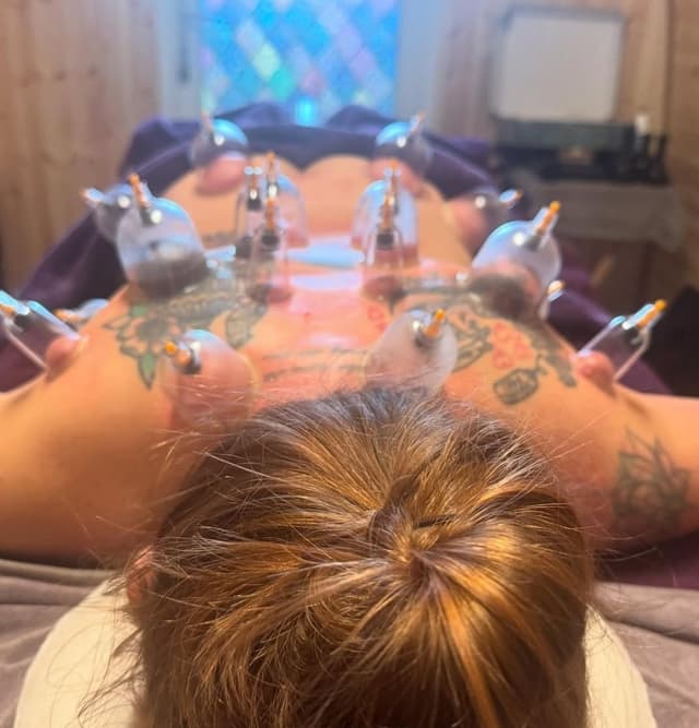 Cupping therapy