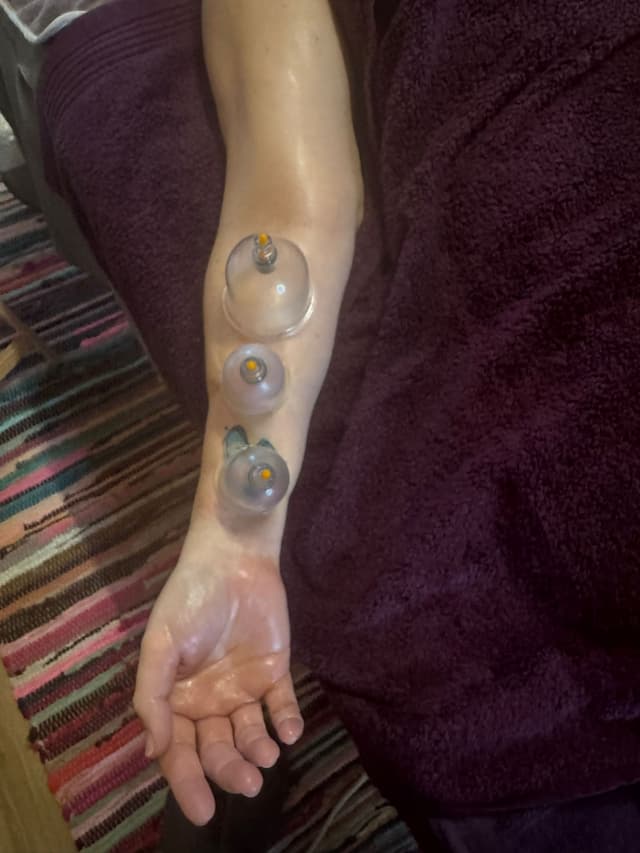 Cupping therapy