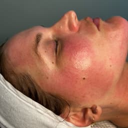 Microneedling with skin boosters