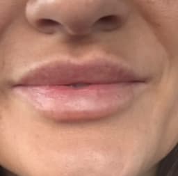Healed Lip Augmentation 💋