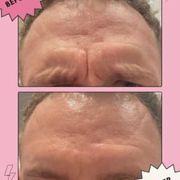 Men's Botox - natural yet smoother
