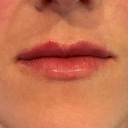 Natural Lip Augmentation- 0.7ml
