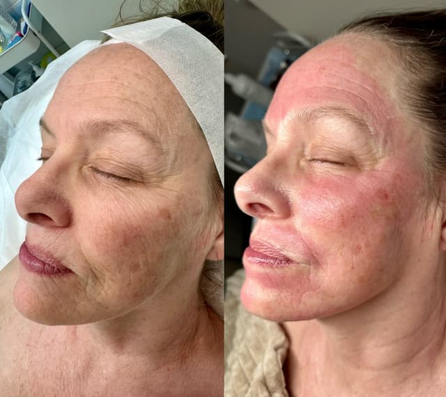 First session of microneedling