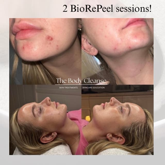 Chemical Peel Facial