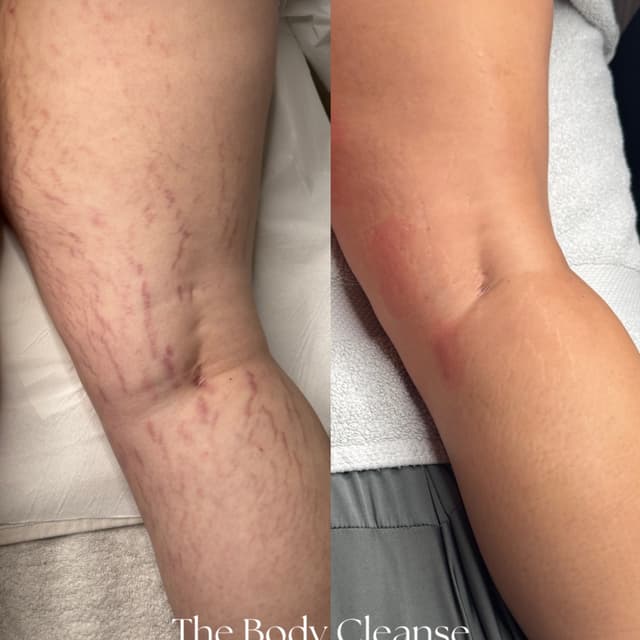 Body Microneedling 🙌🏼