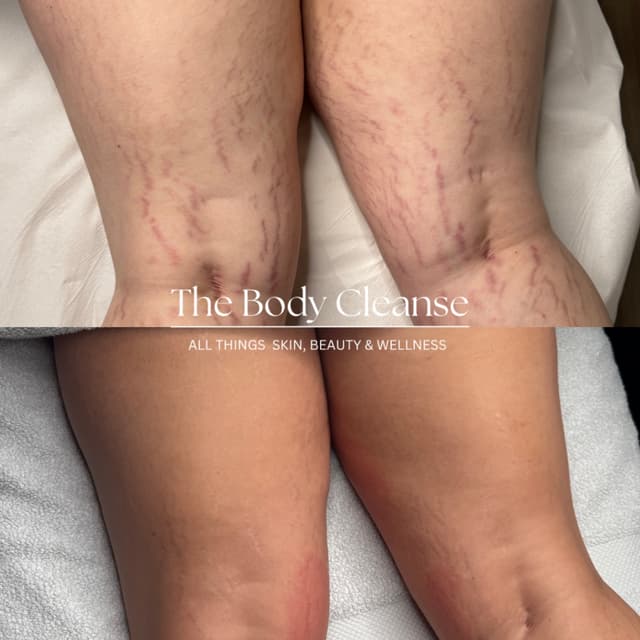 Body Microneedling 🙌🏼