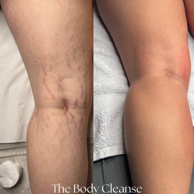 Body Microneedling 🙌🏼
