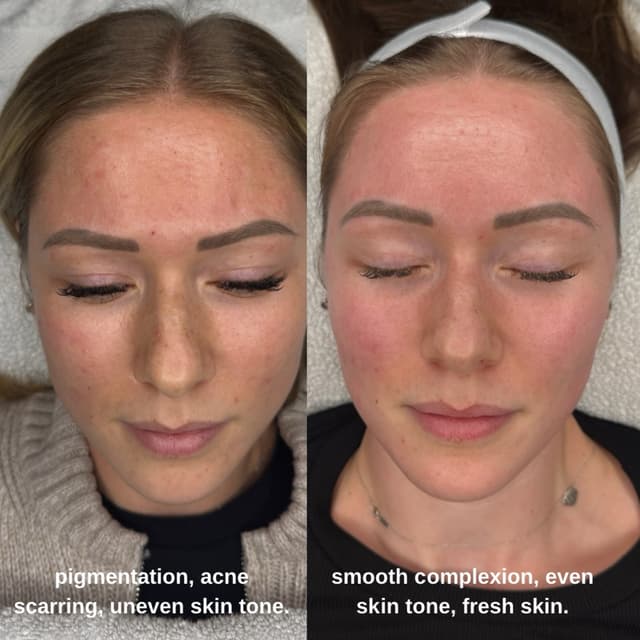 Microneedling 👏🏼