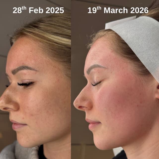 Microneedling 👏🏼