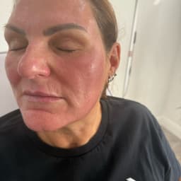 Post Microneedling glow!