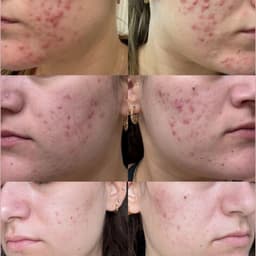 Acne skin care treatment plans