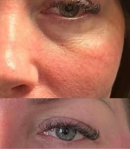 Luxia polynucleotide treatment