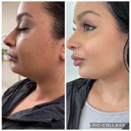 1 week post Luxia Fat dissolving injection treatment