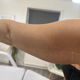 Luxia fat dissolve injection