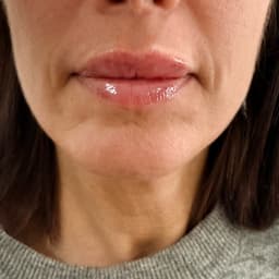 Lip augmentation