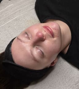 Chemical Peel