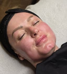 Microneedling Million Dollar Facial