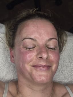 Dermaplaning Facial