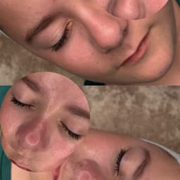 Teen Facial