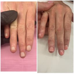 Nail bitting correction 🤍