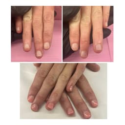 Before & After nail bitting correction