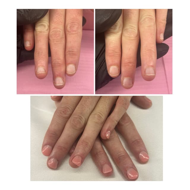Before & After nail bitting correction