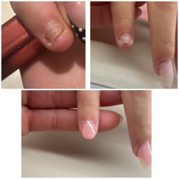 Damaged nail correction