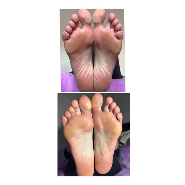 Heel work/hard skin removal