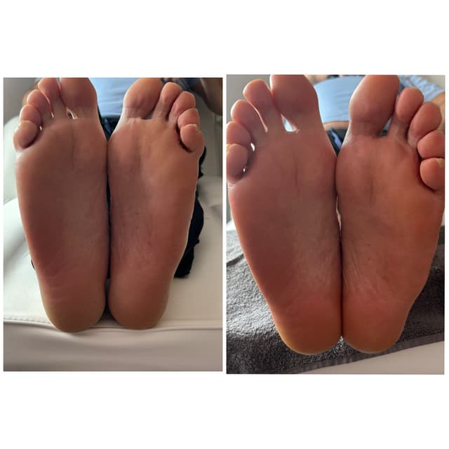 Hard skin removal