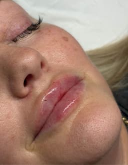 Dermal Filler, Completed using FINE Filler from LuxFill