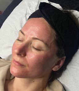 Intense 1.5mm microneedling