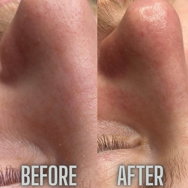 Manual nose extractions before and after