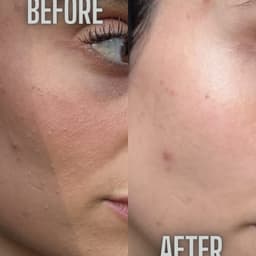 Before and after hydro facial 1 session