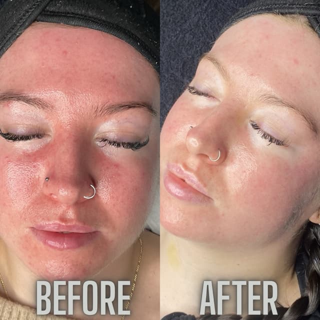Before and after 6 biorepeel session 2 microneedling sessions