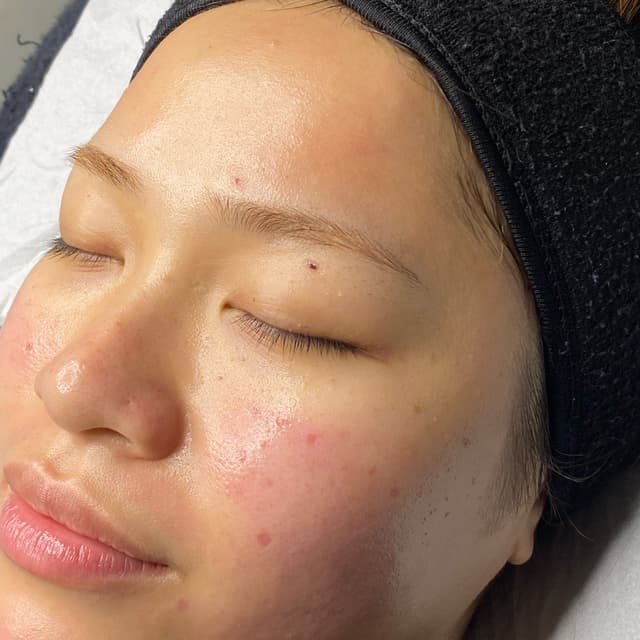 Microneedling