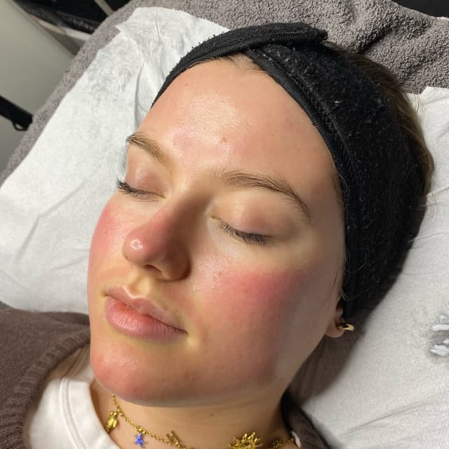 Microneedling and hydro facial