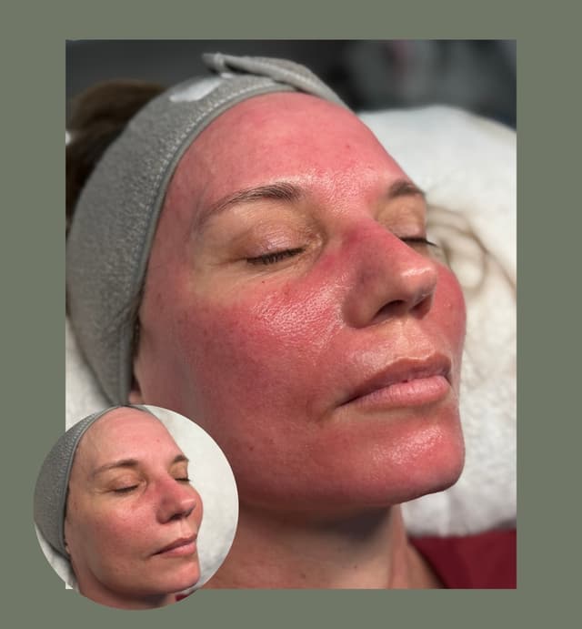 Microneedling -Clinicare tight serum