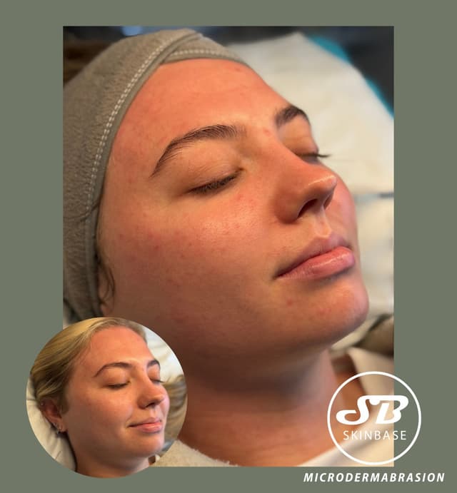Microdermabrasion