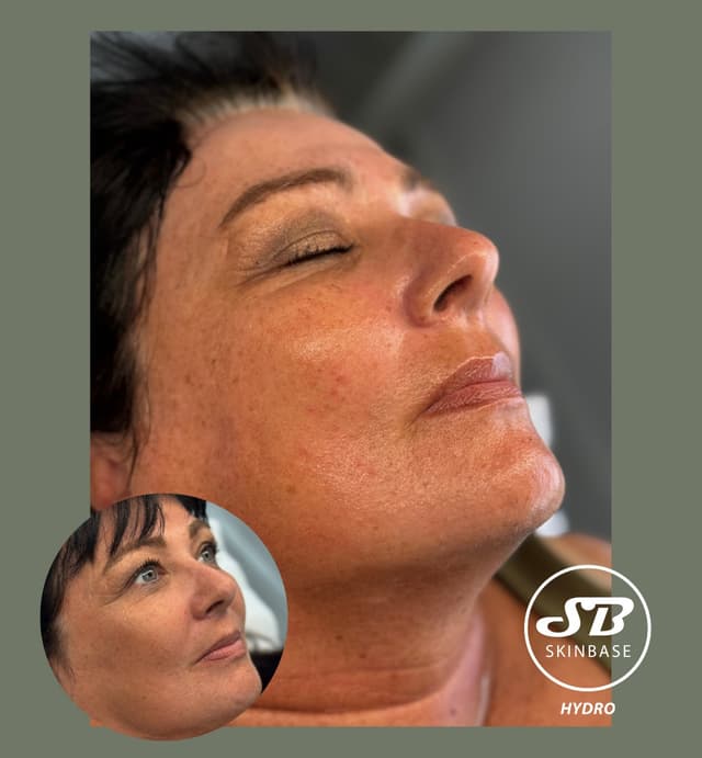 Hydrofacial -Renewing serum