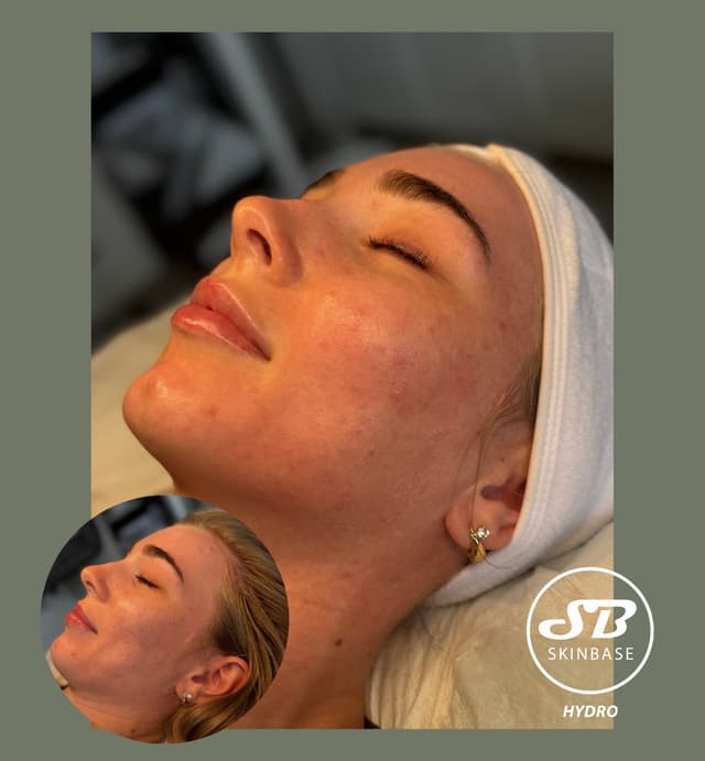 Hydrofacial -Clarifying serum