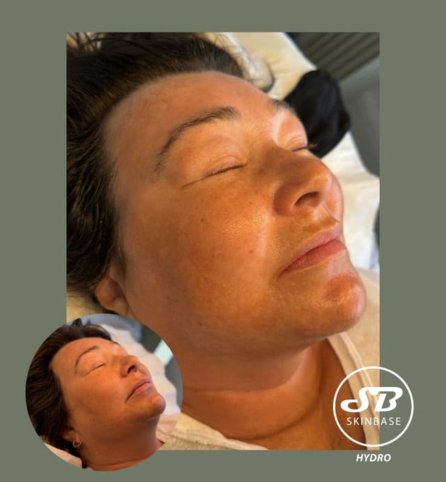 Hydro-Derm Microdermabrasion & hydro combined