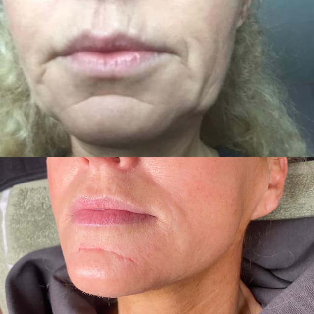 Lower face Anti wrinkle injections