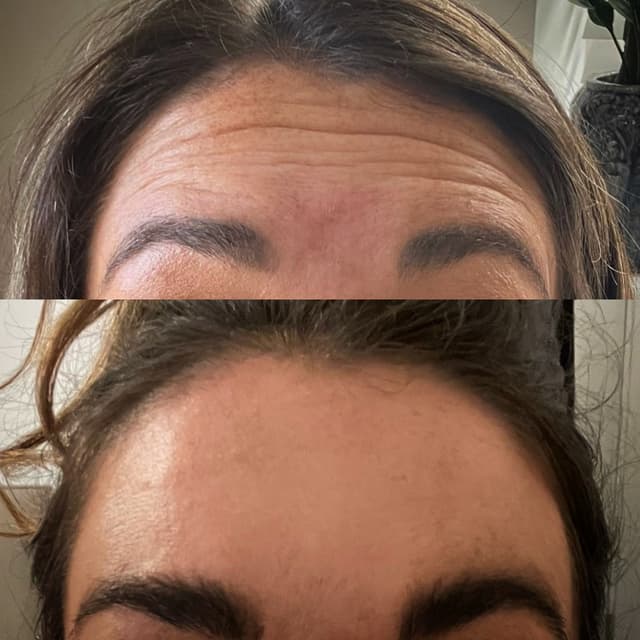 Anti wrinkle results fro 2 areas