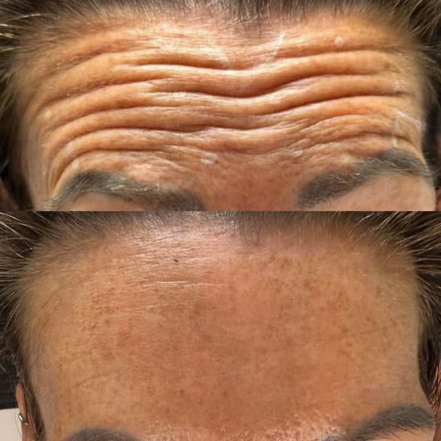 Anti wrinkle results from 2 areas