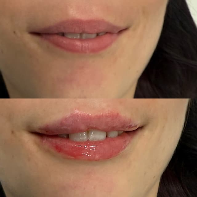 Lip filler