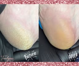 E-Pedi - advanced hard skin removal