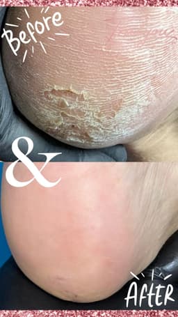 E-Pedi - advanced hard skin removal