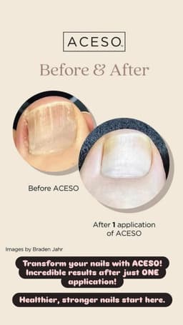 ACESO - Nail recovery program