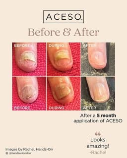 ACESO - Nail recovery program